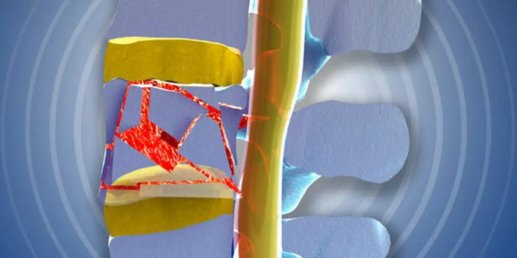 Injuries in the Form of Spinal Fractures