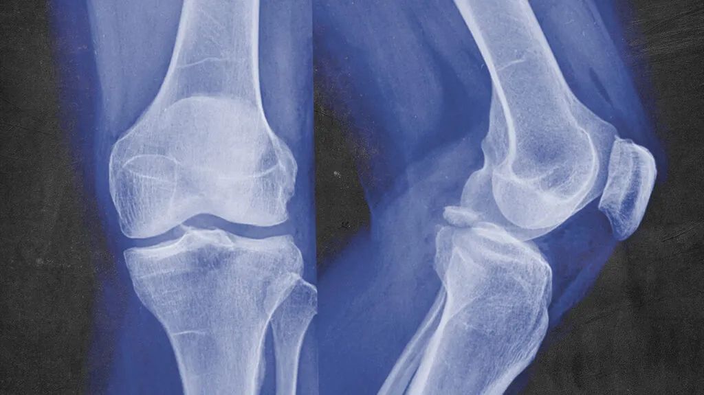 Severe Bone Injury