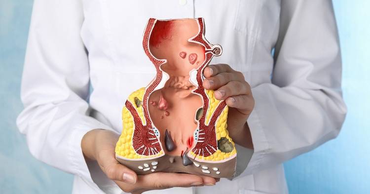 Does Insurance Cover Hemorrhoid Surgery?