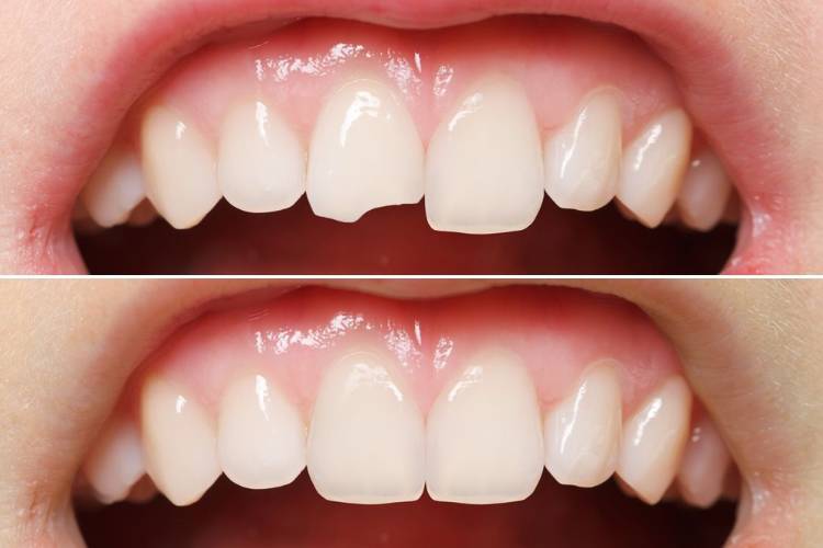 What is Dental Bonding